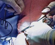 surgery ( stripping and phlebectomy )