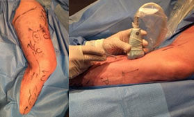 Laser endoveineux