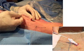 Laser endoveineux
