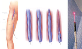 Laser endoveineux