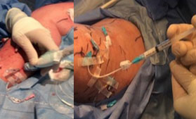 Laser endoveineux
