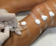 Sclerotherapy